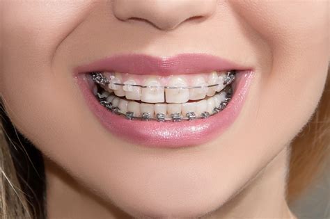 White orthodontics - The Magic of Orthodontics Proper alignment of the teeth is basic to “Smile Design.”. Their position dictates how they work together and affects the way you look and smile. Only orthodontic treatment can move teeth into the right position. Simply put, when things look right, they probably are right. Learn the basics of smile analysis and ...